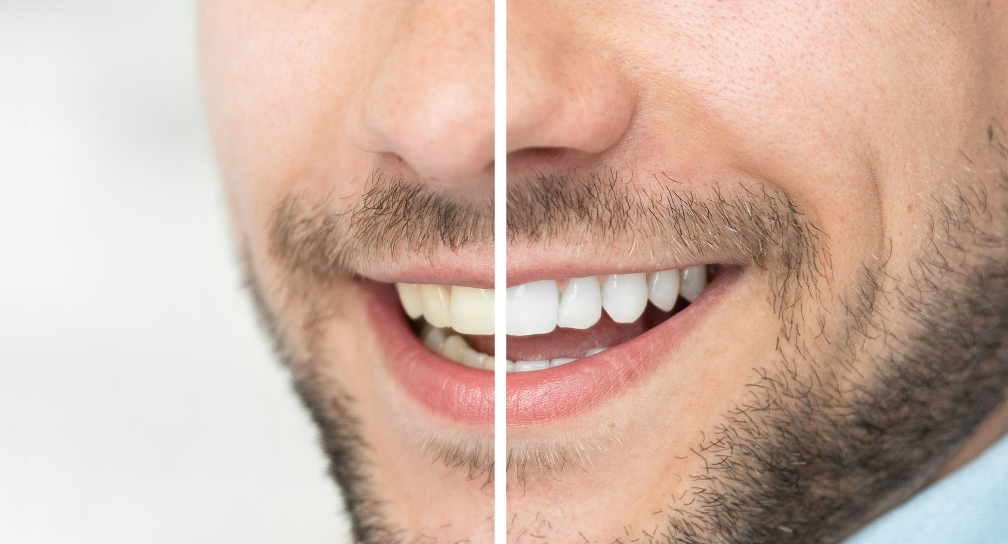 Teeth Whitening Teeth Whitening